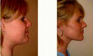 28 Year Old Woman Treated With Chin Liposuction By Dr. Franklin D. Richards, MD, Bethesda Plastic Surgeon