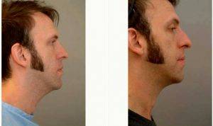 35 Year Old Man Treated With Chin Liposuction By Dr Franklin D. Richards, MD, Bethesda Plastic Surgeon