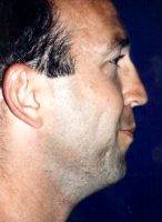 44 Year Old Man Treated With Chin Liposuction With Doctor Juris Bunkis, MD, FACS, Newport Beach Plastic Surgeon