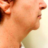59 Year Old Woman Treated With Chin And Face Liposuction, With Neck Lift With Platysmaplasty By Doctor Gregory A. Wiener, MD, FACS, Chicago Plastic Surgeon