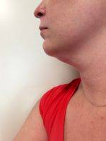 A Chin Liposuction Procedure