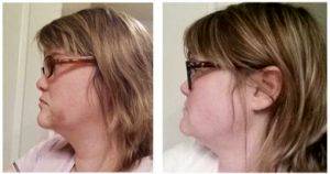 Before And After Neck (chin) Lipo Photos