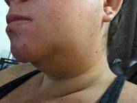 Chin And Neck Liposuction Under Local