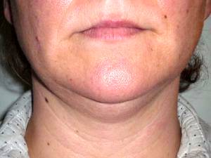 Chin Lipo Price Can Vary From Doctor Or Where You Are Located