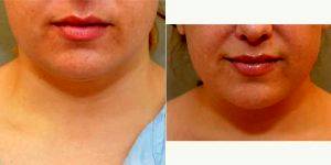 Doctor Keshav Magge, MD, Bethesda Plastic Surgeon - 36 Year Old Woman Treated With Chin Liposuction Local Anesthesia