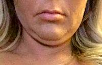 Double Chin In Woman