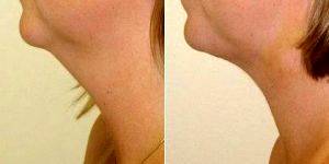 Dr. Lisa J. Peters, MD, Chicago Plastic Surgeon - Chin Liposuction Before And After Images