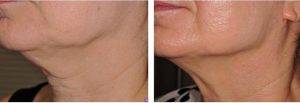 Kybella For Chin Before After Photo
