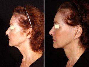 Liposuction Of Neck Before & After By Dr. George J. Beraka, MD , Manhattan Plastic Surgeon