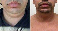 Male Neck Lipo Before And After Photos