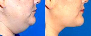 Neck Liposuction Before And After Results
