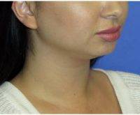 Neck Liposuction Cost Including All Fees Typically Varies Between $3,000 And 5,500