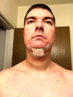 Recovery Time After Double Chin Surgery