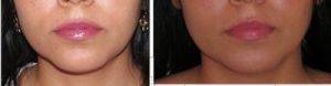 Submental Lipoplasty Before And After