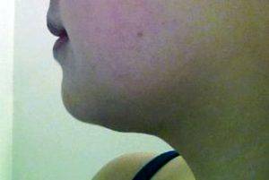 The Chin Can Make The Most Dramatic Change In A Patient’s Appearance