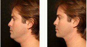 29 Year Old Man Treated With Chin Liposuction Before By Dr. George Toledo, MD, Dallas Plastic Surgeon