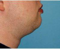 30 Year Old Man Treated With Chin Liposuction PreOp & PostOp By Dr. Karol A. Gutowski, MD, FACS, Chicago Plastic Surgeon