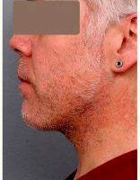 43 Year Old Man Treated With Chin And Jowl Liposuction By Doctor Thomas P. Sterry, MD, New York Plastic Surgeon