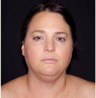 52 Year Old Woman Treated With Chin Liposuction By Dr. Landon Pryor, MD, FACS, Rockford Plastic Surgeon