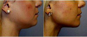 Dr Giancarlo Zuliani, MD, Rochester Facial Plastic Surgeon - 24 Year Old Woman Treated With Chin Liposuction And Small Chin Implant