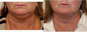 Dr Robert Kratschmer, MD, Houston Plastic Surgeon - 50 Year Old Woman Treated With SmartLipo Triplex With Skin Tightening