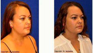 Dr. Ali Sajjadian, MD, FACS, Orange County Plastic Surgeon - Chin And Jowl Liposuction Before And After