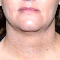 Dr. Elisa A. Burgess, MD, Portland Plastic Surgeon - 36 Year Old Woman Treated With Chin And Jowl Liposuction