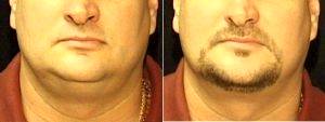 Dr. Mark Anton, MD, FACS, Newport Beach Plastic Surgeon - Male Neck Liposuction