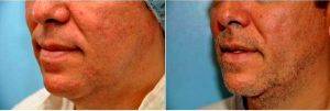 Dr. Tanveer Janjua, MD, Bedminster Facial Plastic Surgeon - Chin And Jowl Liposuction