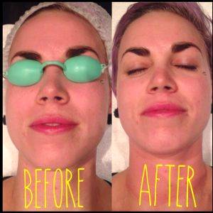 Fraxel Laser Face Treatment Before And After
