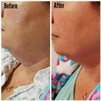 Lipodissolve Chin Before And After