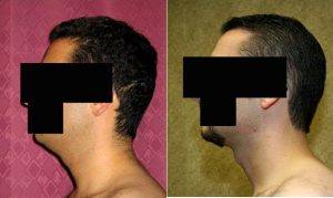 Liposuction Of Neck Jaw Line For Men Before By Dr. Sean Younai, MD, FACS, Beverly Hills Plastic Surgeon
