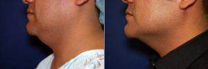 Male Chin Lipo Before With Dr Jennifer Reichel, MD, Seattle Dermatologist