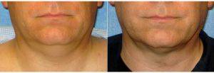 Male Chin Liposuction Before By Dr. George John Alexander, MD, FACS, Las Vegas Plastic Surgeon
