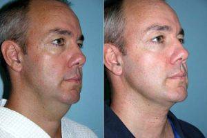 Male Submental Liposuction Before With Doctor Jose Perez-Gurri, MD, FACS, Miami Plastic Surgeon