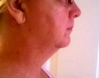 Neck Liposuction And Lift Candidate