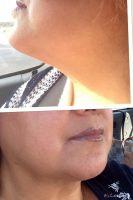 Neck Liposuction Preop And Postop