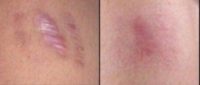18-24 year old woman treated with Scar Removal