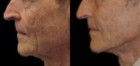 79 year old woman treated with Neck Lift