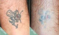 25-34 year old man treated with Tattoo Removal