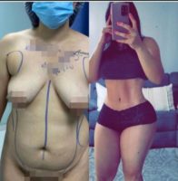 18-24 year old woman treated with Tummy Tuck