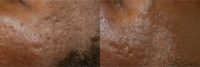 35-44 year old man treated with Injectable Fillers