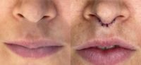 35-44 year old woman treated with Lip Lift