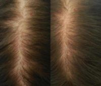 45-54 year old woman treated with Thinning Hair