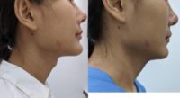 25-34 year old woman treated with Adam's Apple Reduction