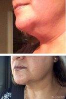 Lipo Of The Chin Before And After Pic