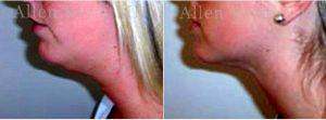 29 Year Old Woman Treated With Chin Liposuction Double Chin Correction By Dr Allen Rezai, MD, London Plastic Surgeon