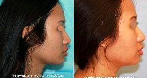30 Year Old Woman Treated With Chin Liposuction Before And After With Doctor B. Kalantarian, MD, Orange County Plastic Surgeon