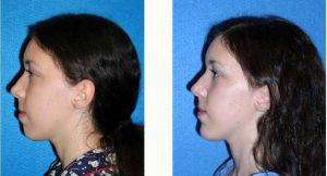 31 Year Old Woman Treated With Chin Liposuction By Dr Scott D. Green, MD, Sacramento Plastic Surgeon