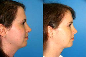 33 Yr Old With Liposuction Of The Neck By Dr William LoVerme, MD, Boston Plastic Surgeon